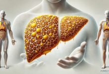 Homeopathic Medicine for Fatty Liver Disease